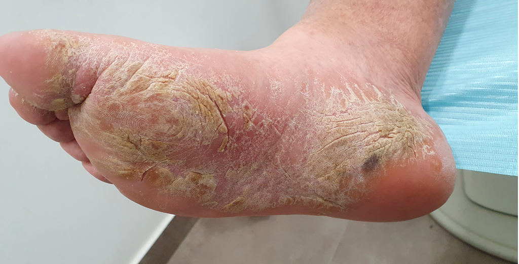 El abuso de esmaltes permanentes puede dañar las uñas de los pies  Rioja  Salud
